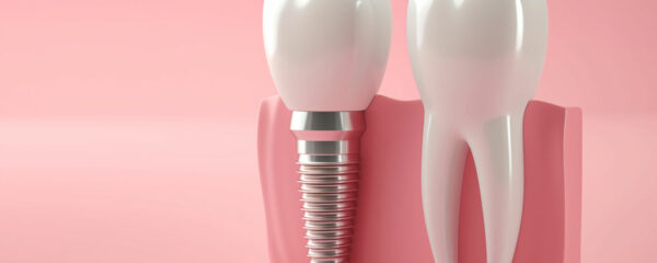 implants dentaires