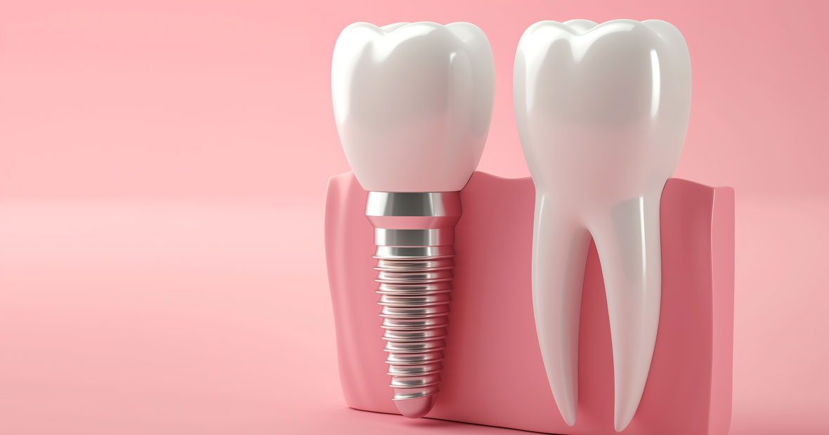 implants dentaires